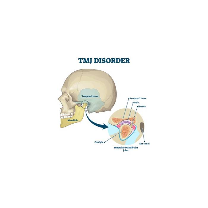 What is tmj disorder