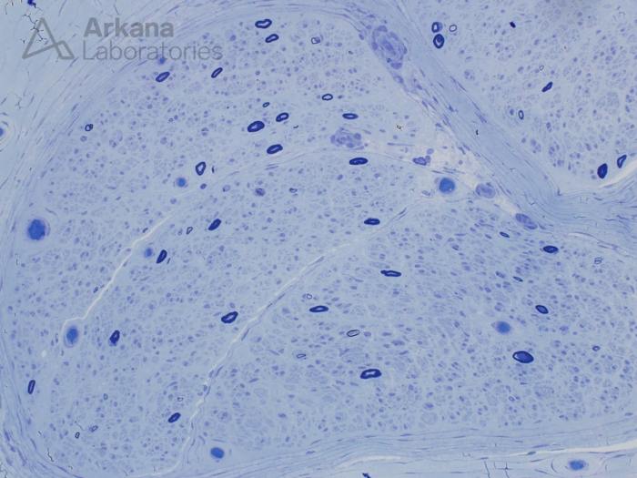 Hattr amyloidosis with polyneuropathy