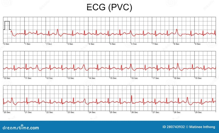 Premature ventricular complexes pvcs