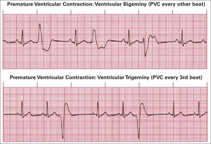 Premature Ventricular Contractions Treatment Cape Town