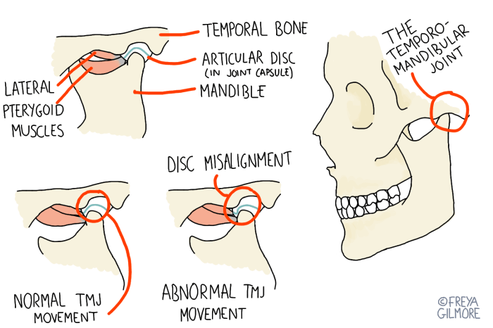 What is tmj disorder