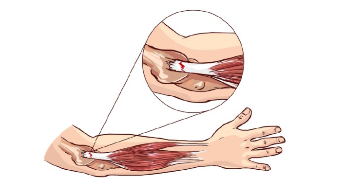 Traditional, Conservative Treatments for Tennis Elbow | HSS Surgery for tennis elbow