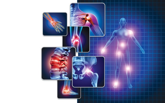 Autoimmunity neuroinflammation in fibromyalgia