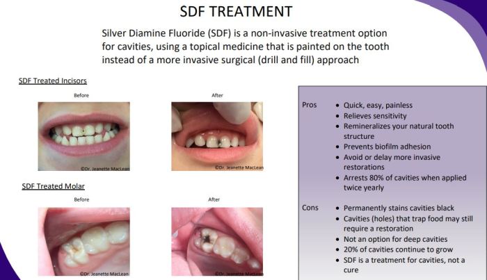 Sliver diamine fluoride vs sealants