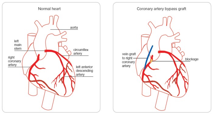 What is quadruple bypass heart surgery