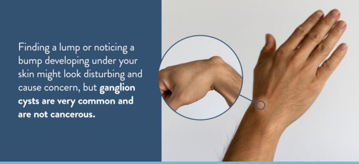 Weird bumps on hand, wrist, and arm, not painful, not itchy. What are ... Hand and wrist lumps and bumps