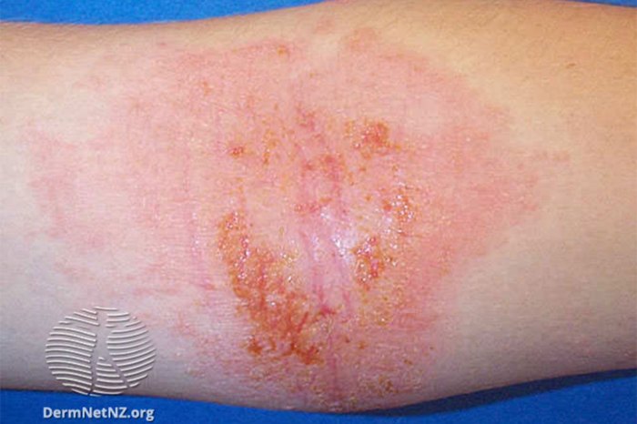 Eczema and covid vaccine
