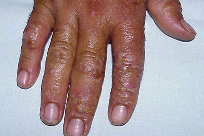 Weeping eczema overview and more