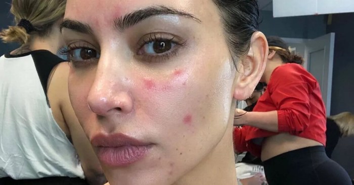 Kim Kardashian's tears over psoriasis flare-ups at 'most important moments' of her life - Mirror ... Skin pain in psoriasis