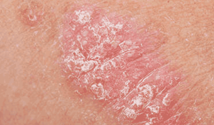 Como Se Cura La Psoriasis? - Tipos de Psoriasis y Sus Tratamientos - Psoriasis Tratamiento ... Skin pain in psoriasis