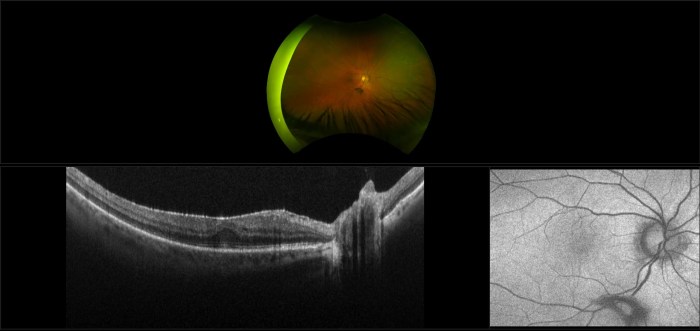 BILATERAL EPIRETINAL MEMBRANE FORMATION AFTER INTRAVITREAL I ... Epiretinal membrane retinal scar tissue
