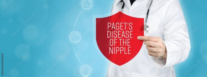 Pagets disease of the breast