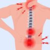 Rheumatoid Arthritis Back Pain Understanding the Impact