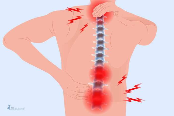 What Is the Best Treatment for Arthritis in the Lower Back? Rheumatoid arthritis back pain