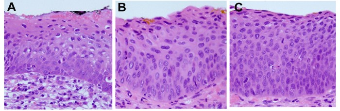 What is cervical intraepithelial neoplasia