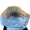 Retrognathia Recessed Lower Jaw A Comprehensive Guide