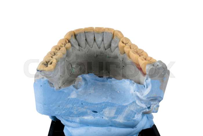Retrognathia recessed lower jaw