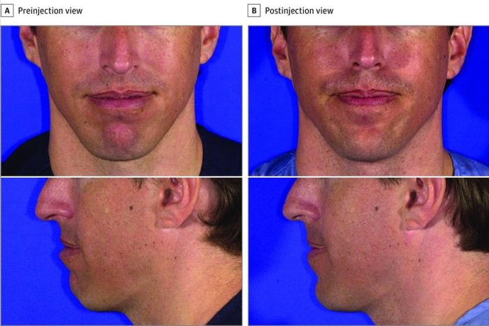 Does my lower jaw look recessed it looks really short : r/jawsurgery Retrognathia recessed lower jaw
