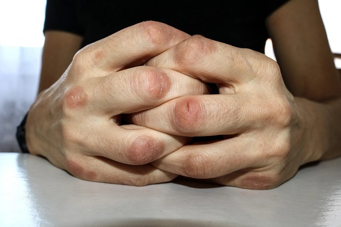 What medications treat psoriatic arthritis