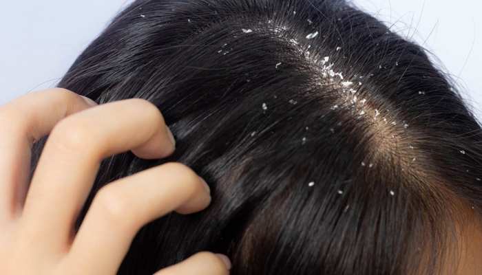 Scalp psoriasis vs dandruff