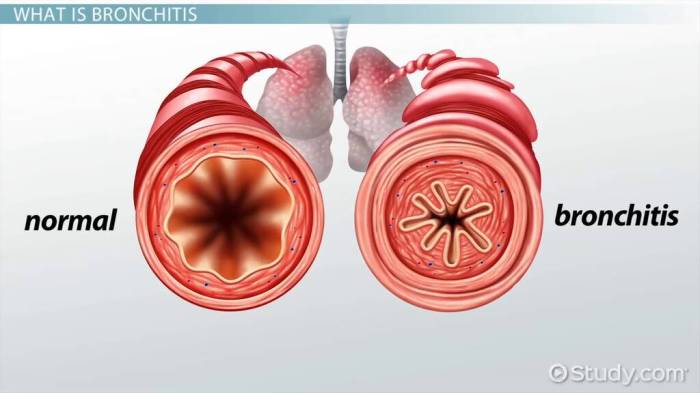 Bronchitis asthma types symptoms