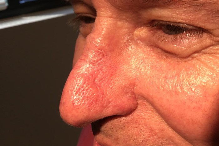 Mohs surgery on nose