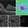 Macular Telangiectasia Eye Disease A Deep Dive