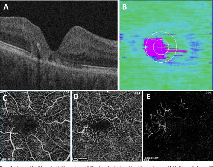 Right-angled vessels in macular telangiectasia type 2 | British Journal of Ophthalmology