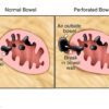 Whats a Bowel Perforation? A Deep Dive