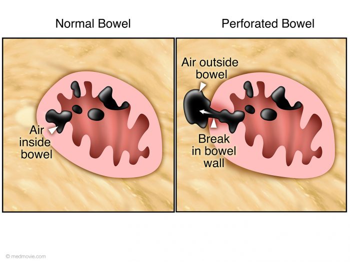Whats a bowel perforation