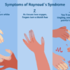 Raynauds Syndrome Chronic Fatigue A Deep Dive