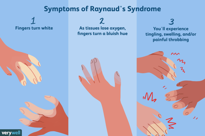 The dynamic natural skin care: Raynaud's phenomenon - Raynaud's disease symptoms Raynauds syndrome chronic fatigue
