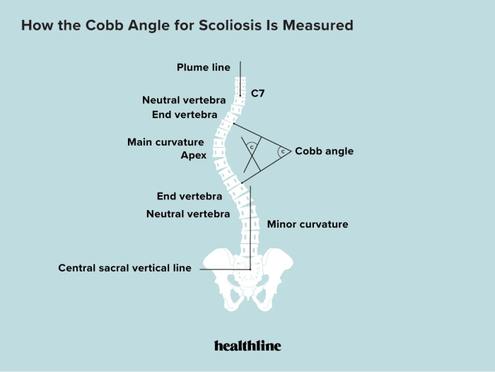 Cobb Angle for Scoliosis: Definition and Uses Cobbs angle and scoliosis
