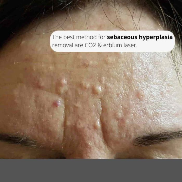 Best Sebaceous Hyperplasia Treatments In Australia - vrogue.co Sebaceous hyperplasia causes symptoms and treatments