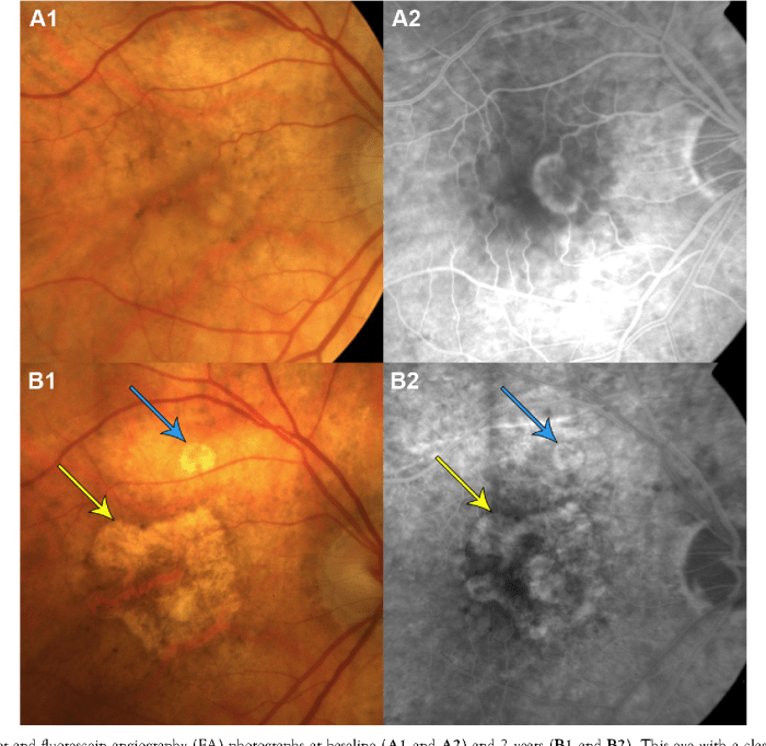 Epiretinal Membrane Orlando | Central Florida Retina Epiretinal membrane retinal scar tissue