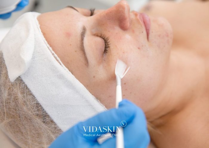 What is Acne Surgery? A Deep Dive