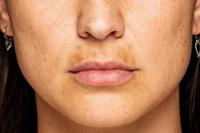 Hyperpigmentation on Buttocks Causes, Treatments & Prevention