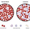 Major Differences Between Leukemia and Lymphoma