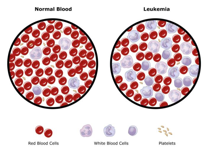 Major differences between leukemia and lymphoma