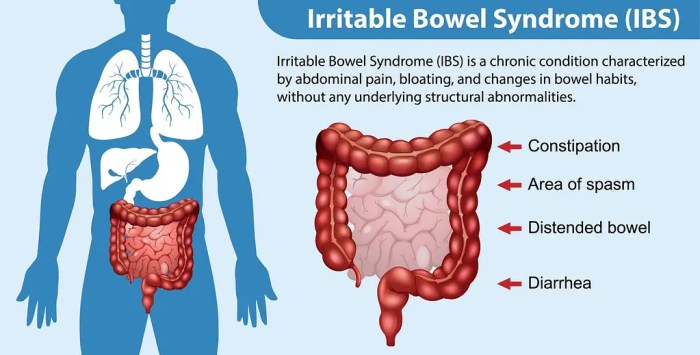 Facts about irritable bowel syndrome