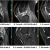 ACL Tears After Surgery A Comprehensive Guide