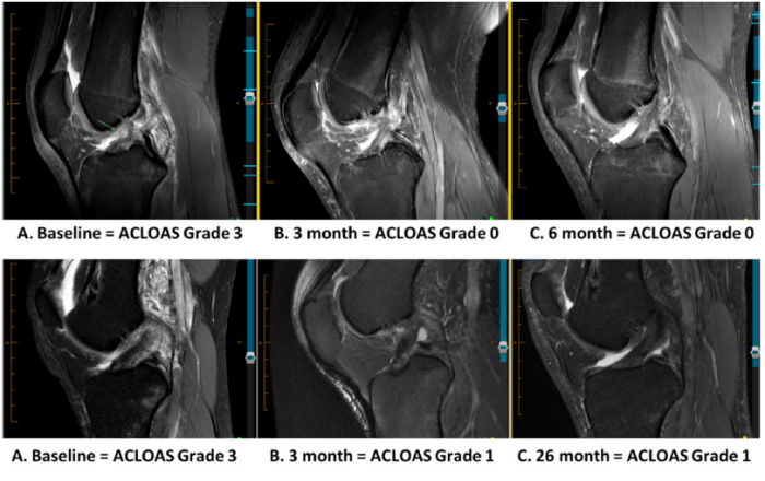 ACL Tears After Surgery A Comprehensive Guide