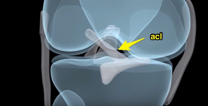 How acl surgery is performed