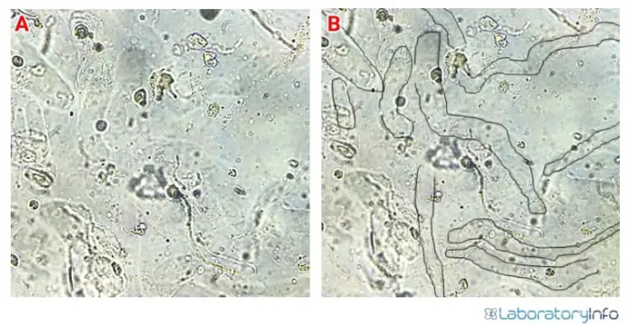 Hyaline casts in urine