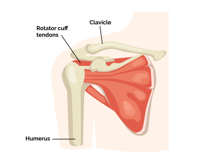 Rotator cuff tear surgery