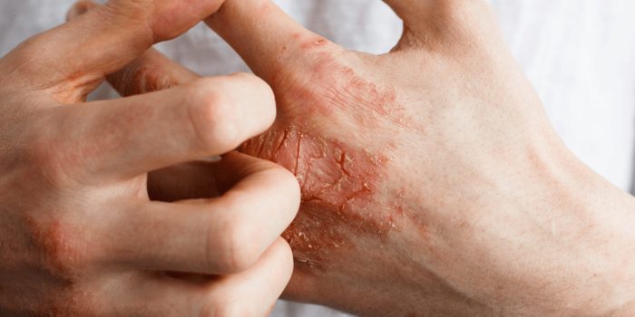 Eczema on face treatment