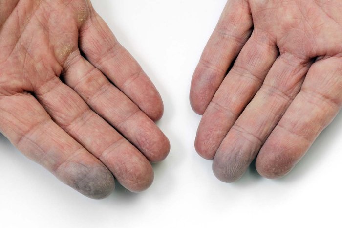NHS.UK widget Raynauds syndrome chronic fatigue