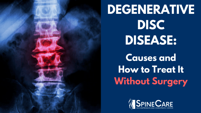 Preventing degenerative disc disease