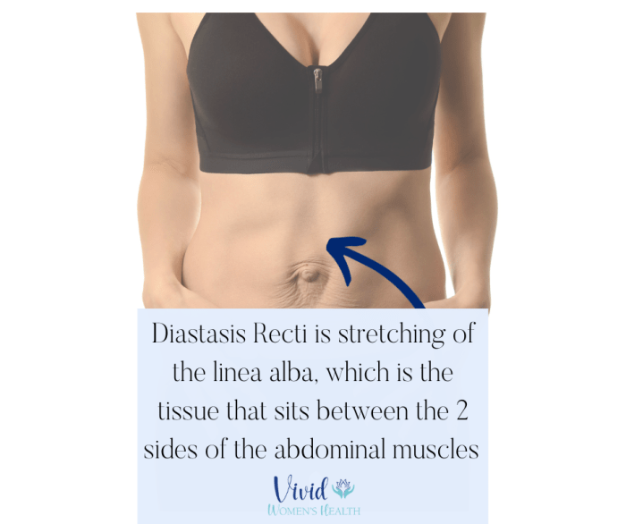 Treating diastasis recti with physical therapy