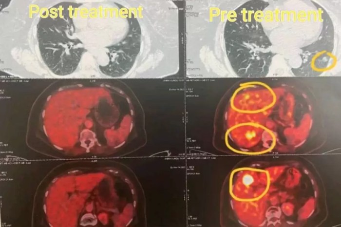 Treatments for HER2 Positive Breast Cancer A Comprehensive Guide